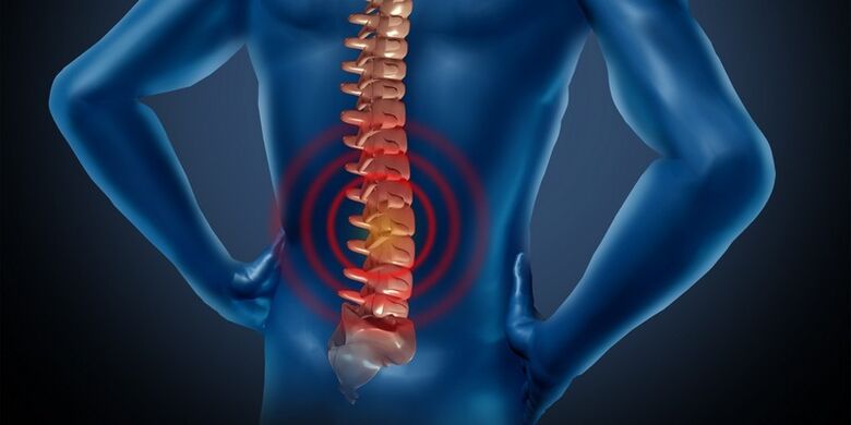 Osteochondróza bedrovej oblasti