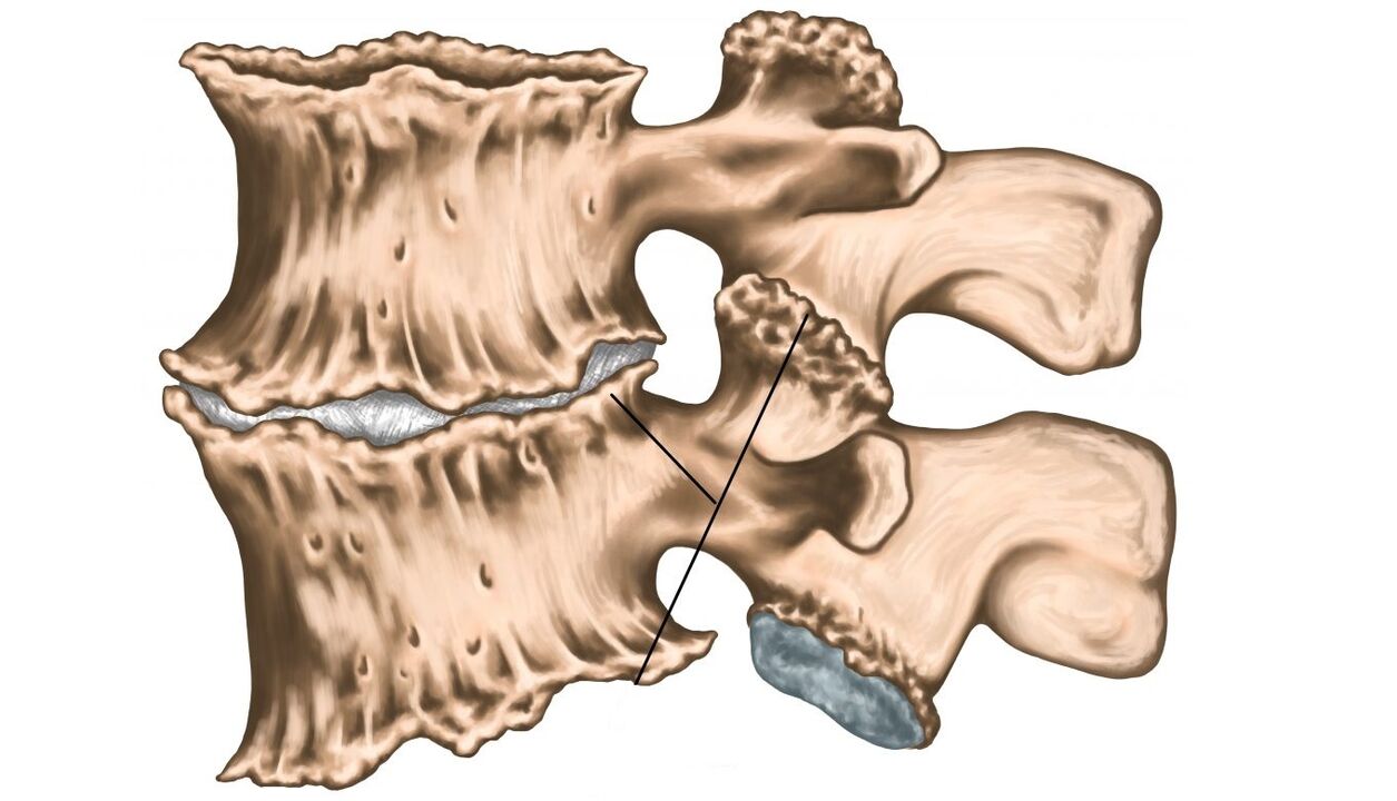 lézie chrbtice v dôsledku osteochondrózy