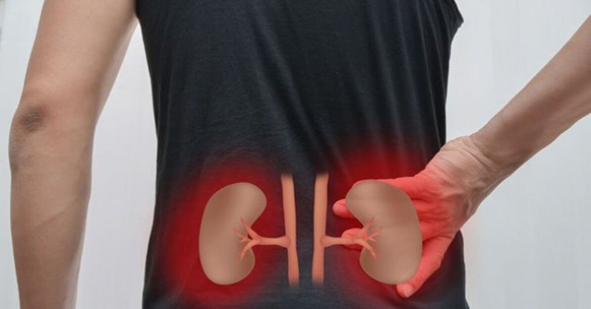 Zápal obličiek môže spôsobiť bolesť dolnej časti chrbta