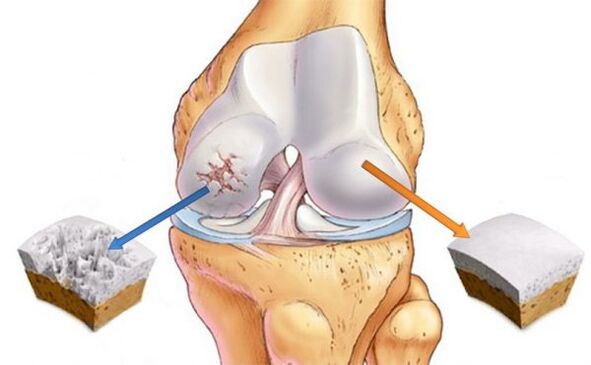 Osteoartritída kolenného kĺbu (vľavo) a normálnej chrupavky (vpravo)