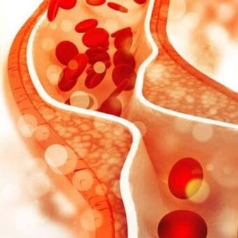 Ukladanie cholesterolu na vnútorných stenách krvných ciev vyvoláva bolesť na boku krku
